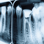 إمكانية استبدال علاج قناة الجذر بعلاج تجديد الأنسجة لأمراض عصب الأسنان