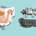 From an Interim Denture to a Bar-Overdenture in One Visit? The Secret is the "Hybrid Workflow"!